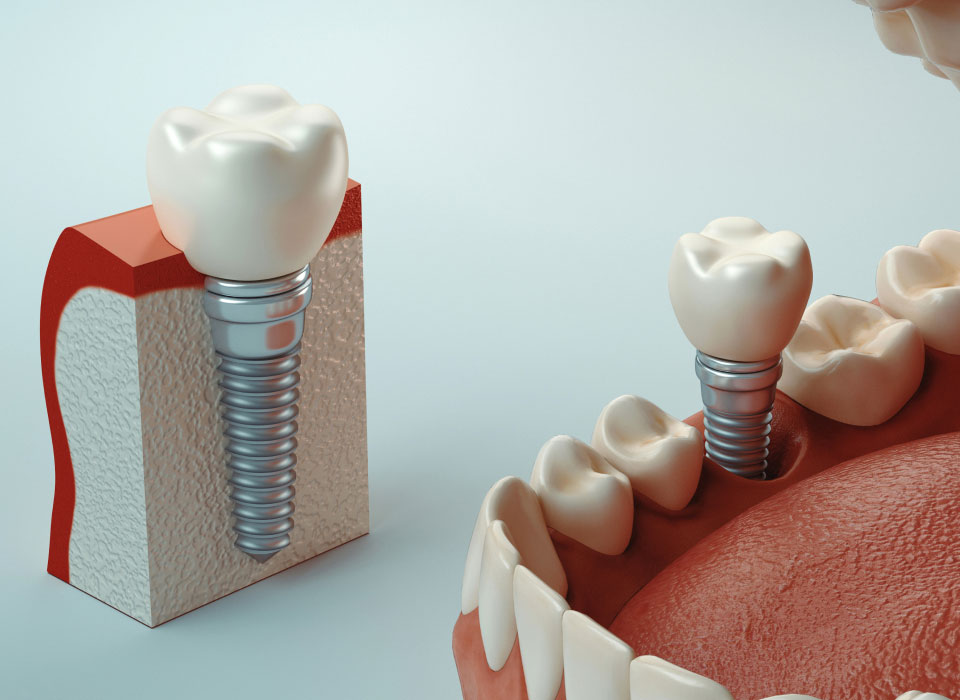 Dental implant showing a dental crown secured to an implant post, with gum and jawbone detail.