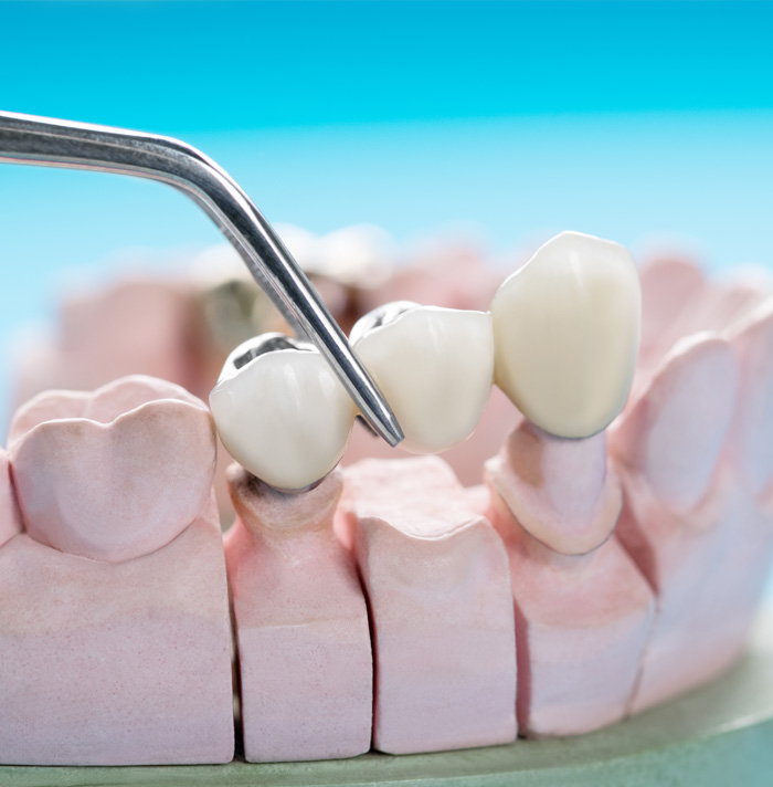 Dental model showcasing a pair of dental implants being placed using metal tweezers.