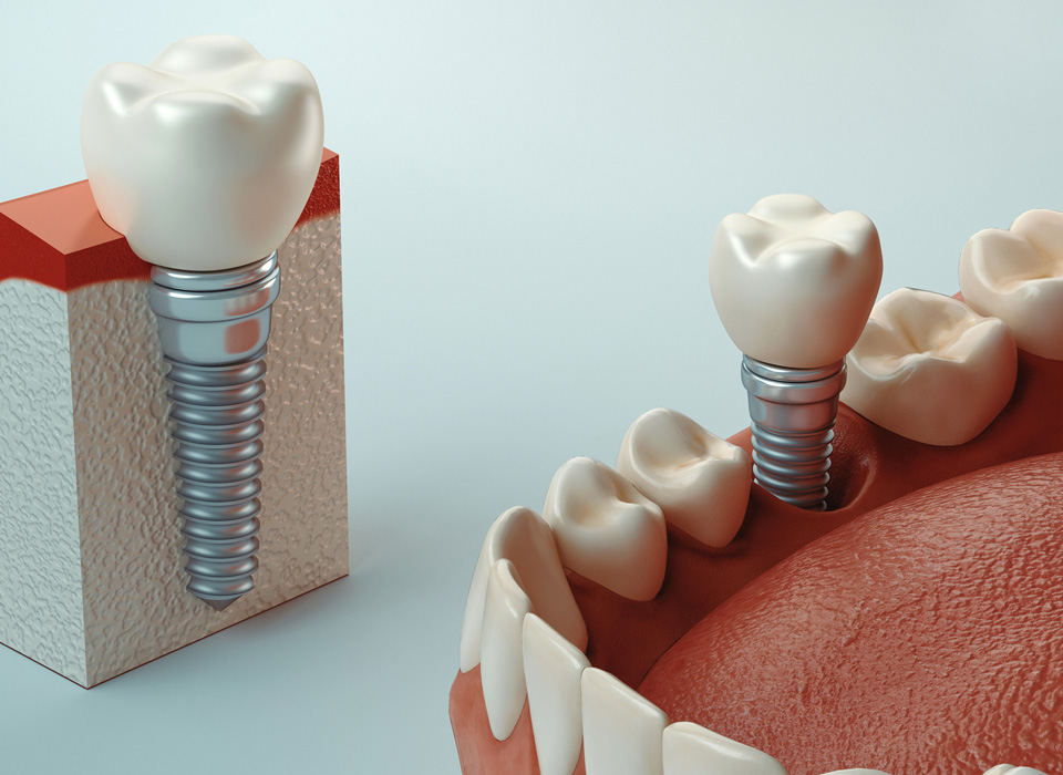 Dental implant showing a dental crown secured to an implant post, with gum and jawbone detail.