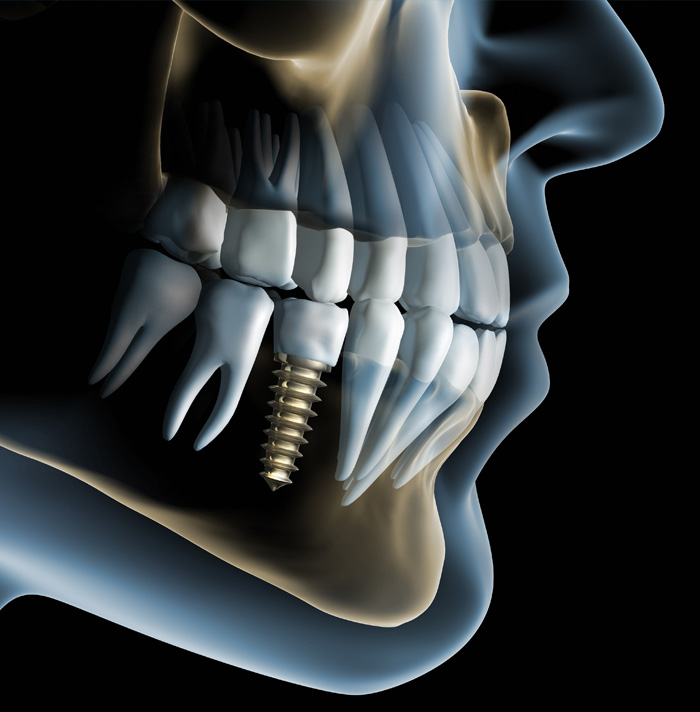 Dental implant showing a screw-like fixture in the jawbone, surrounded by teeth.