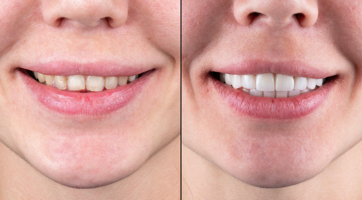 Featured image for Are Veneers Good for Your Teeth?