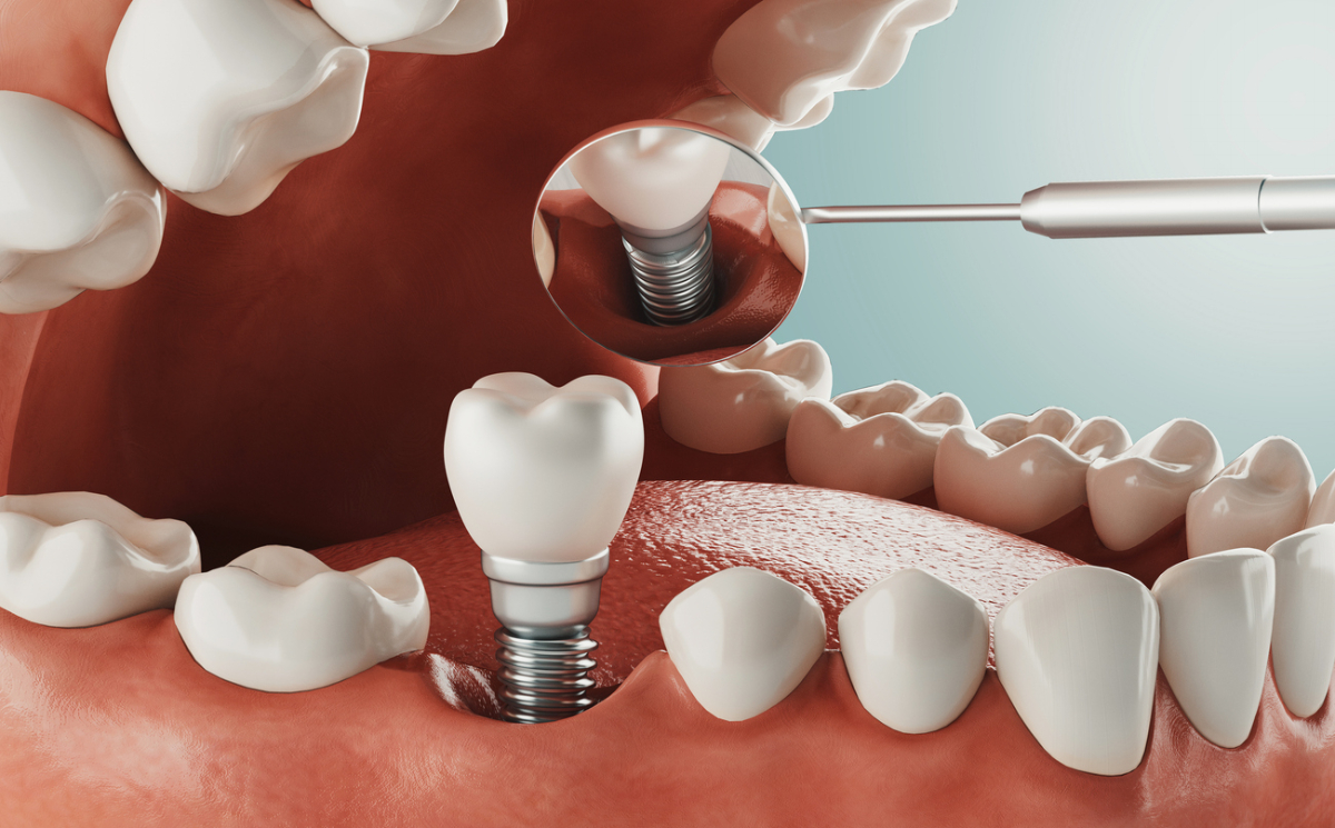 Featured image for Is Getting a Dental Implant Painful?